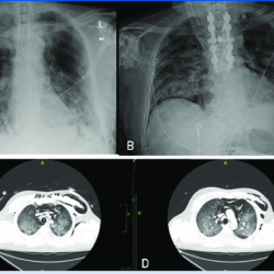 You are transporting a stable patient with a possible pneumothorax