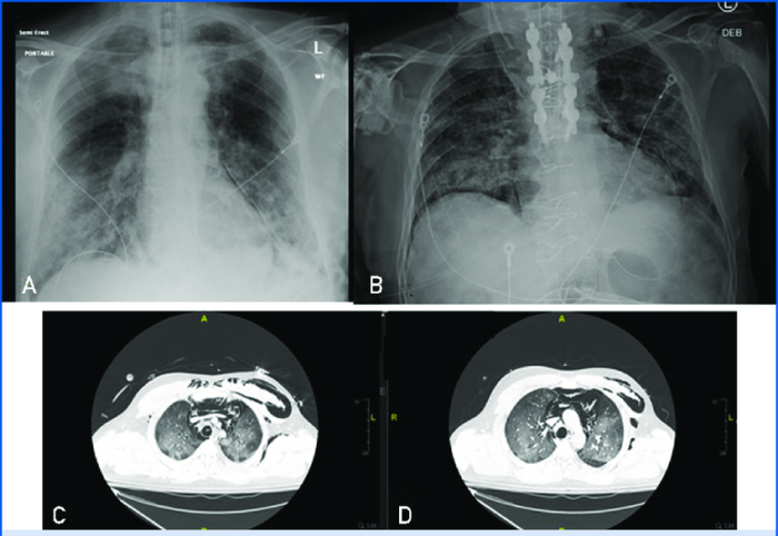 You are transporting a stable patient with a possible pneumothorax